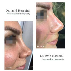 فرم دهی بینی با ژل - جاوید حسینی