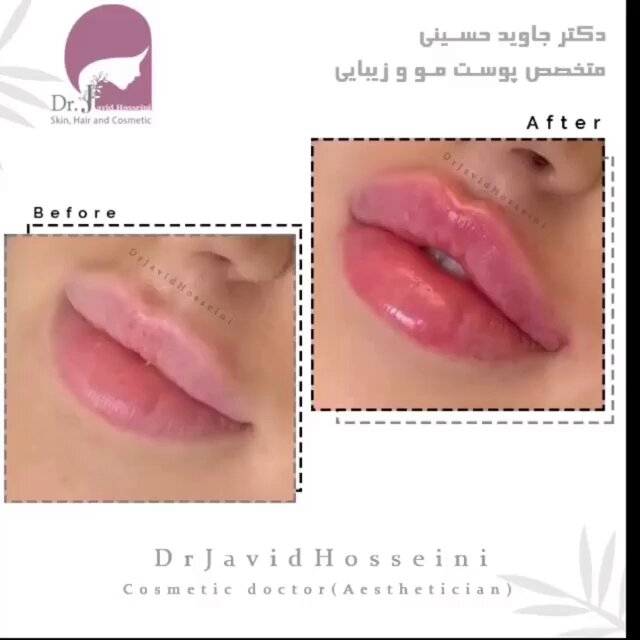 آنچه باید از تزریق ژل لب بدانید