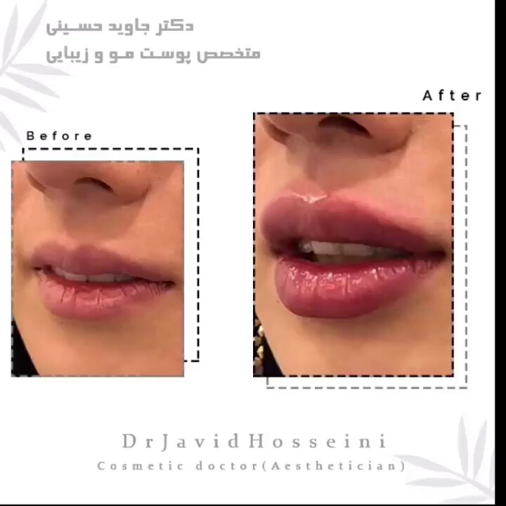 مزایای تزریق ژل لب