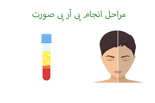 مراحل انجام پی آر پی صورت