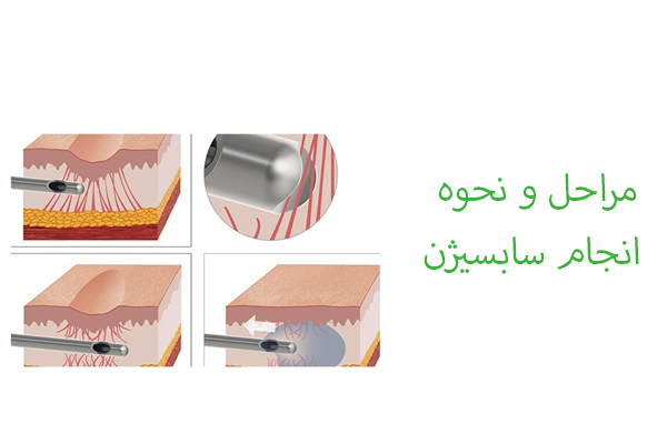 مراحل و نخوه انجام سابسیژن