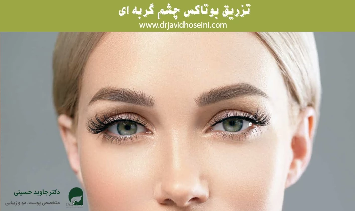 تزریق بوتاکس چشم گربه ای