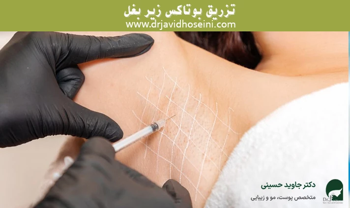 تزریق بوتاکس زیر بغل