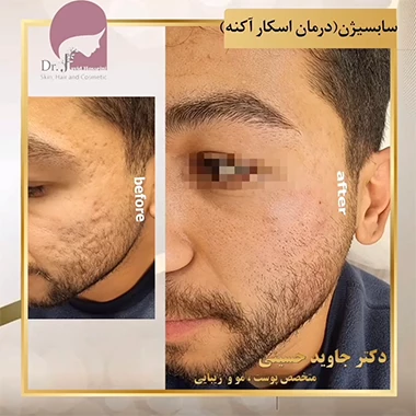 درمان جای جوش با سابسیژن