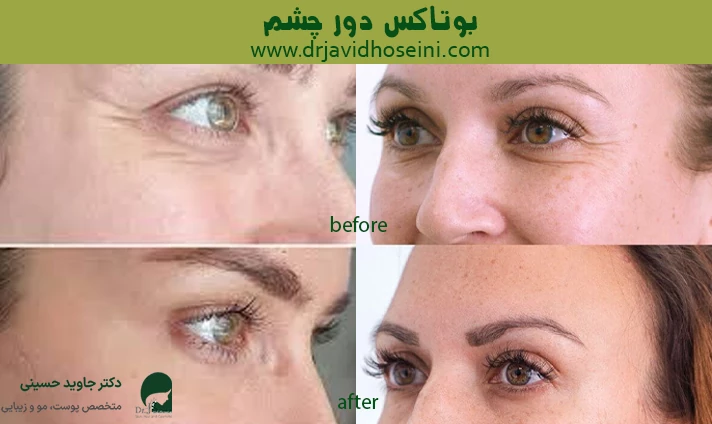 بوتاکس دور چشم