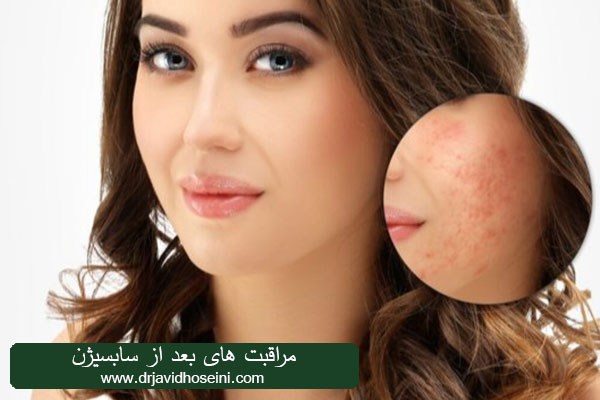 مراقبت های بعد از سابسیژن