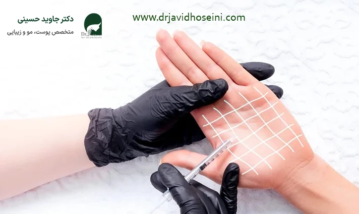 مراقبت های قبل و بعد تزریق بوتاکس کف دست
