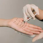 مزایای تزریق بوتاکس کف دست