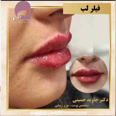 تزریق فیلر چیست؟