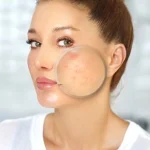 قرمزی پوست از عوارض سابسیژن