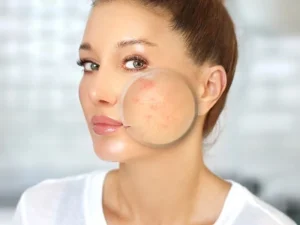 قرمزی پوست از عوارض سابسیژن