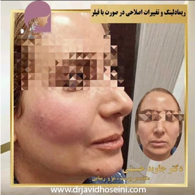 نمونه کار تزریق فیلر