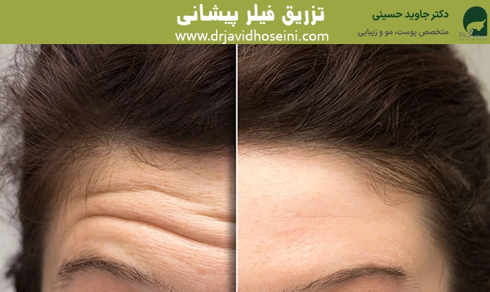 تزریق فیلر پیشانی