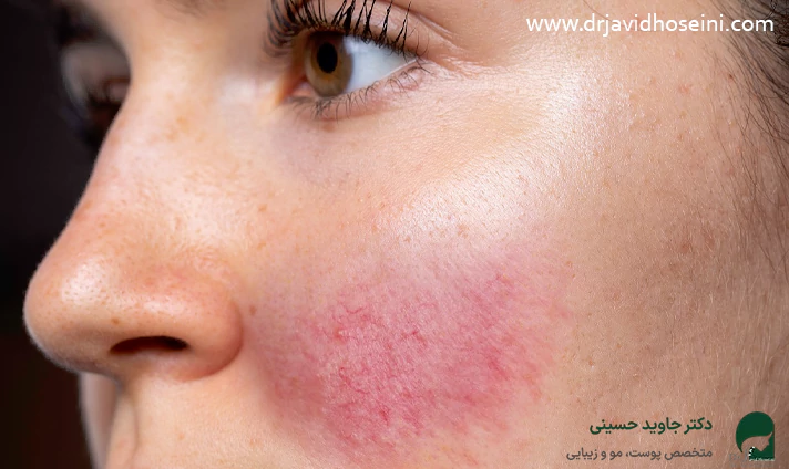 علائم حساسیت و آلرژی به بوتاکس