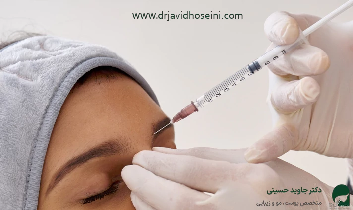 مزایای تزریق فیلر پیشانی