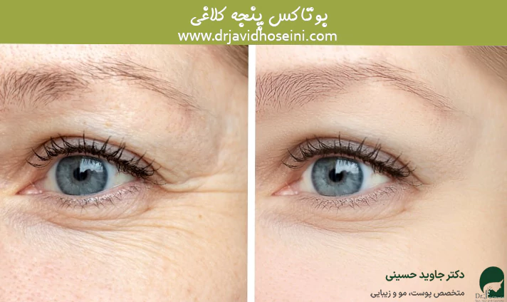 بوتاکس پنجه کلاغی
