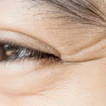 تزریق بوتاکس خطوط پنجه کلاغی