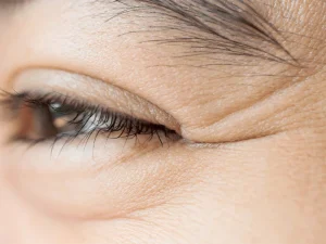 تزریق بوتاکس خطوط پنجه کلاغی