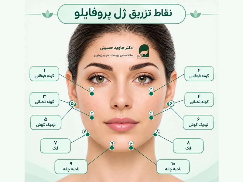 نقاط تزریق ژل پروفایلو